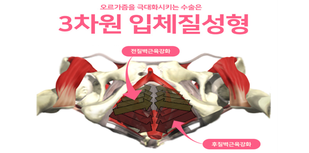3차원 입체질성형