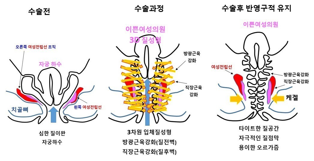 이쁜이수술