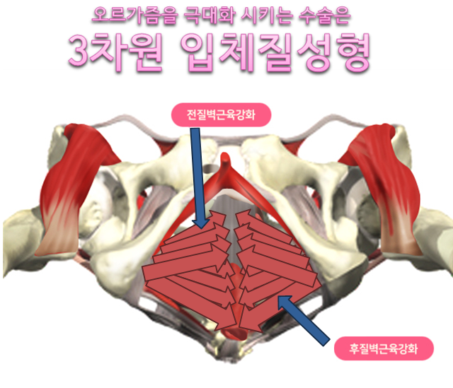이쁜이수술