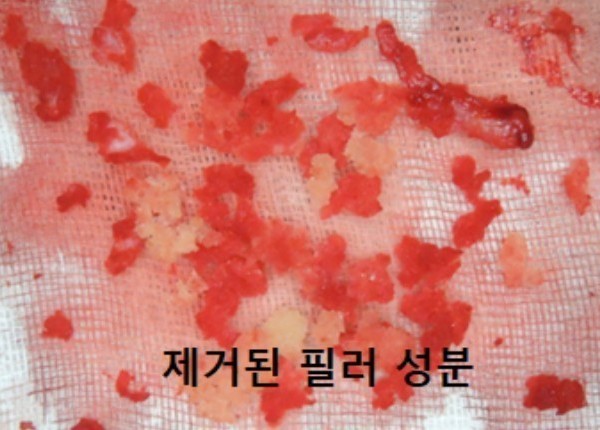 이물질제거 볼/탭