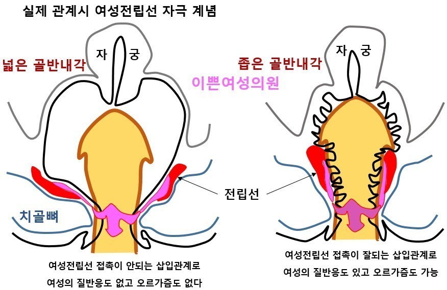 이쁜이수술