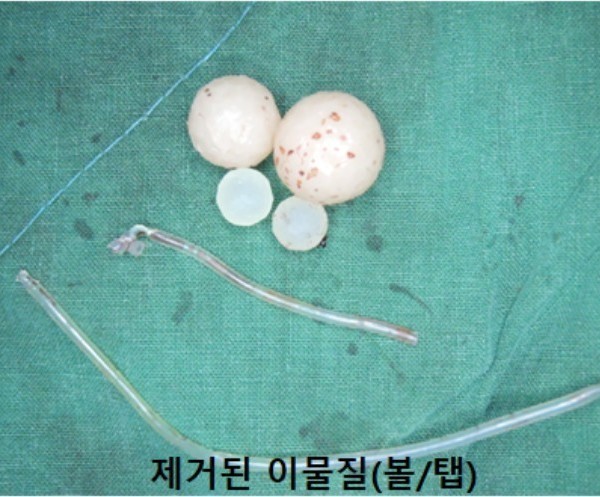 이물질제거 볼/탭