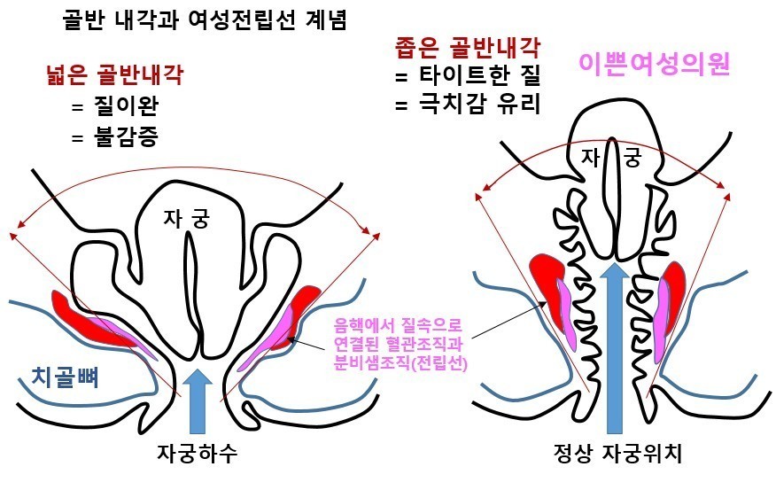 이쁜이수술